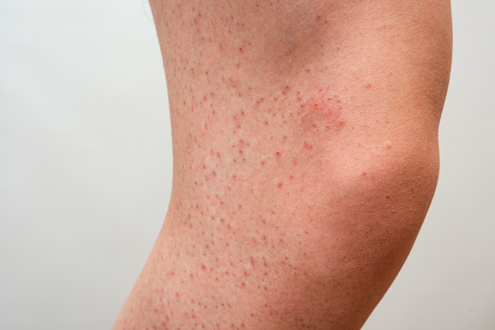 Natural Ways To Get Rid Of Strawberry Legs